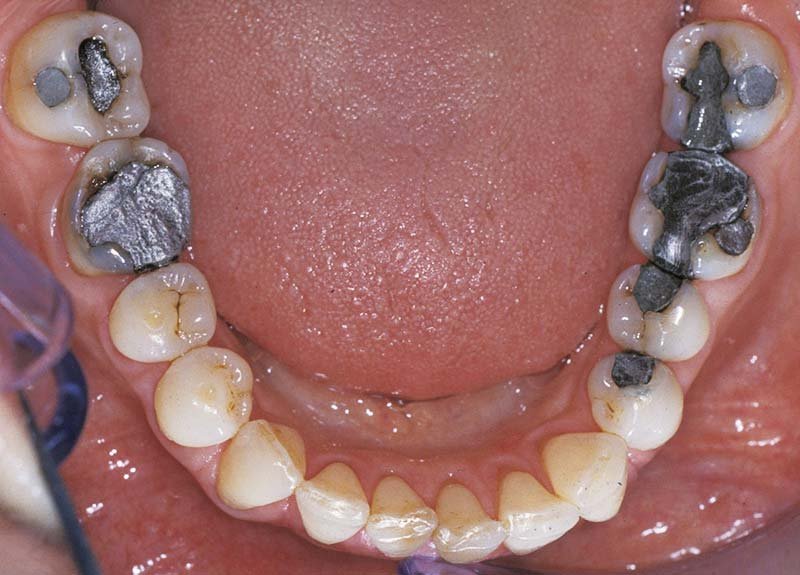 Symptoms of Mercury Toxicity